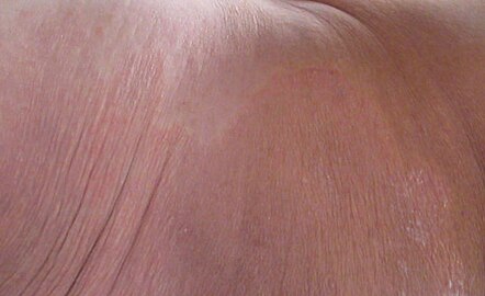 Tinea Corporis, right buttock