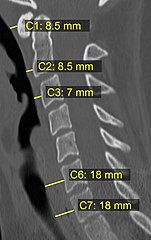 CT scan with upper limits of the thickness of the prevertebral space at different levels.[12]