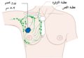 مرحلة 2A في سرطان الثدي