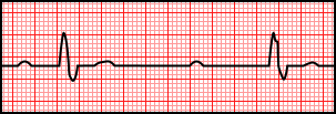 3rd Degree AV Block.svg