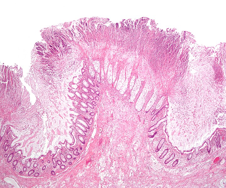 File:Colonic pseudomembranes low mag.jpg