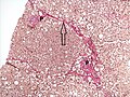 Histopathology of steatohepatitis with moderate fibrosis, with thin fibrous bridges (Van Gieson's stain)[95]