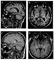 Die T1-gewichteten sagittalen (A) und axialen (B) MRTs zeigen ein symmetrisch hohes Signal im Thalamus (das sogenannte Pulvinar Sign) eines 66-jährigen männlichen Patienten. (C) und (D), ebenfalls T1-gewichtet, zeigen das Pulvinar Sign bei einem 42-jährigen Patienten.