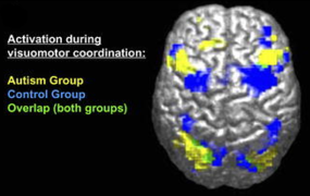 "An image of an autistic mind versus a typical mind." Lastly, we can evade an photograph at all. I think the medical image would be the most accurate image as a header for such an expansive topic.