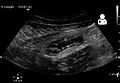 Ultrasound showing appendicitis and an appendicolith[60]