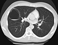 Thumbnail for Congenital pulmonary airway malformation