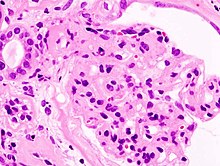 Diabetic glomerulosclerosis (1) HE.jpg