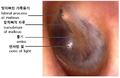 Tympanic membrane viewed by otoscope