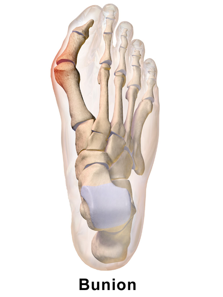 File:Bunion.png