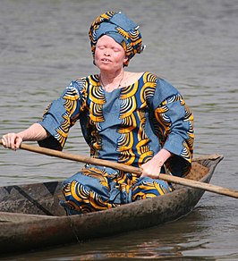 Albinovrouw in Benin