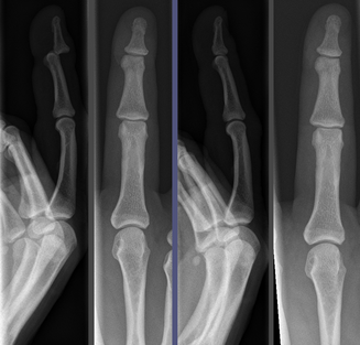 A dislocated finger bone before and after reduction