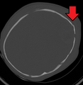 A skull fracture from abusive head trauma in an infant