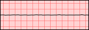 Asystole.svg