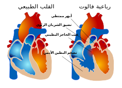 الفرق بين القلب الطبيعي والقلب في رباعية فالوت.