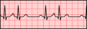 Premature Atrial Complexes.svg