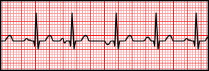 Multifocal Atrial Tachycardia.svg