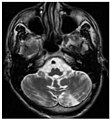 File:Morbus Fabry Stroke 01.jpg