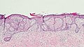 Fibroepitheliomatous pattern (anastomosing basaloid epithelial strands enclosing round islands of fibrous stroma)[36]