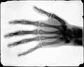 Buckwalter's 1896 X‑ray of a hand