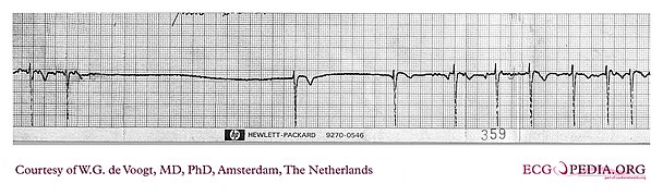 DVA0381 (CardioNetworks ECGpedia).jpg