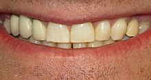 MildFluorosis02-24-09.jpg