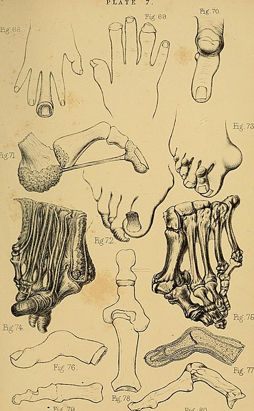 File:The malformations, diseases and injuries of the fingers and toes and their surgical treatment (1866) (14779670002).jpg