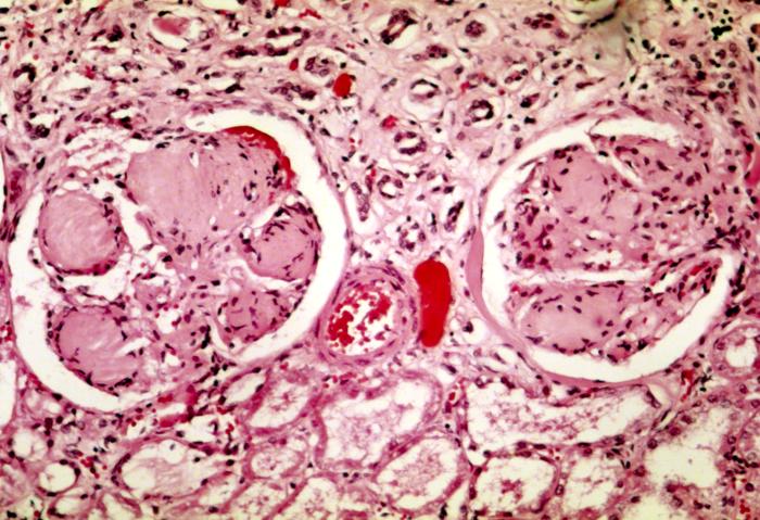 File:Nodular glomerulosclerosis.jpeg