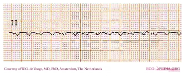 DVA0217 (CardioNetworks ECGpedia).jpg