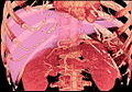 MDCT image. 3D image created by MDCT can clearly visualize the liver, measure the liver volume, and plan the dissection plane to facilitate the liver transplantation procedure.