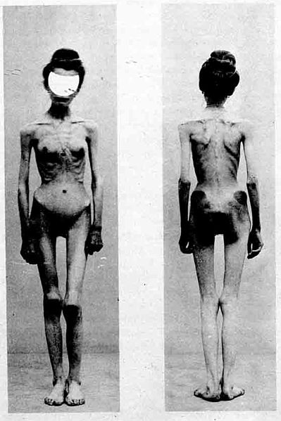 File:Anorexia case-1900-Nouvelle icononographie de la Salpetriere.jpg