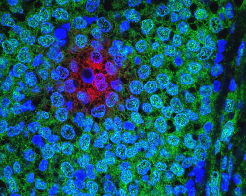 Breast cancer cells. (Credit: <a href="https://visualsonline.cancer.gov/details.cfm?imageid=10574" target="_blank">NCI</a>)