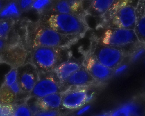 Triple-negative breast cancer cells (blue). (Credit: <a href="https://visualsonline.cancer.gov/details.cfm?imageid=10502" target="_blank">NCI</a>)