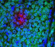 Breast cancer cells. (Credit: <a href="https://visualsonline.cancer.gov/details.cfm?imageid=10574" target="_blank">NCI</a>)