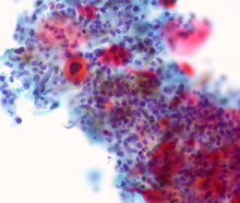 Lung squamous cell carcinoma cells (Credit: <a href="https://flic.kr/p/efq3fp" target="_blank">Ed Uthman/Flickr</a>)