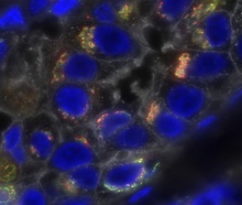 Triple-negative breast cancer cells (blue). (Credit: <a href="https://visualsonline.cancer.gov/details.cfm?imageid=10502" target="_blank">NCI</a>)