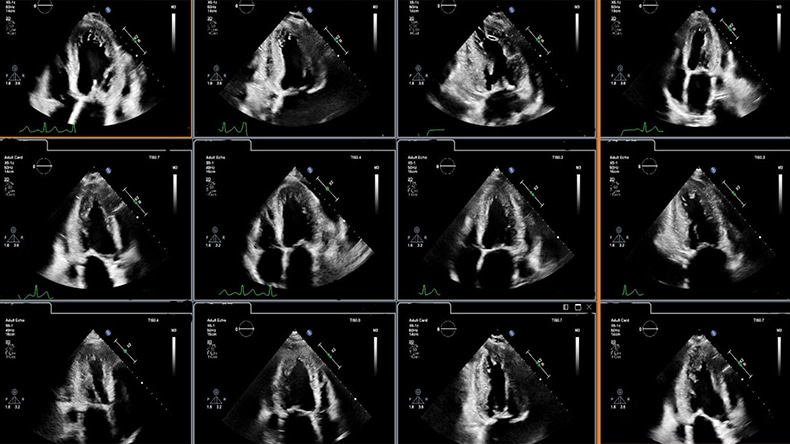 Clinical image showing cardiac ultrasound display for image analysis enhanced through integration of AI -  