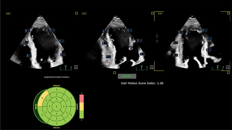 Clinical image showing how integrating AI into cardiac ultrasound provides automated segmental wall motion scoring -  