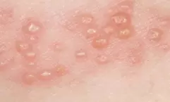 Varicella zoster virus: chickenpox and shingles
