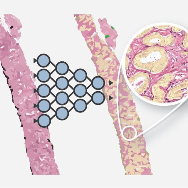 Gleason Grading of Prostate Biopsies (non-normalized) Logo